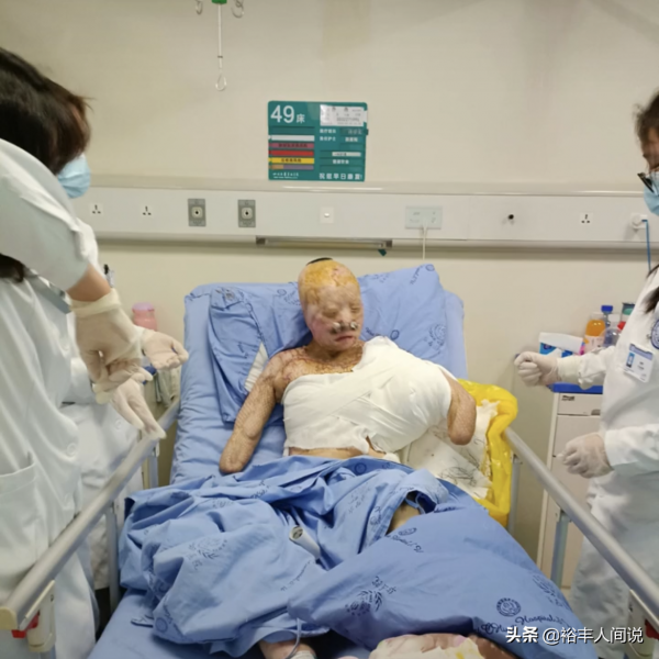 24岁女孩烧伤928天后重生!12次手术仍不放弃,向河南灾情捐500元