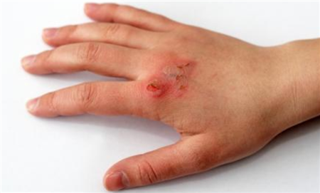 在乔纳森服用了拉莫三嗪这种抗抑郁的药物不到一个月后,他就开始感觉