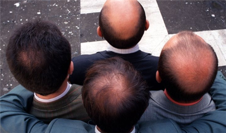 为何秃顶的人,宁可只剩一根头发也不理光头?答案令人出意料(2)