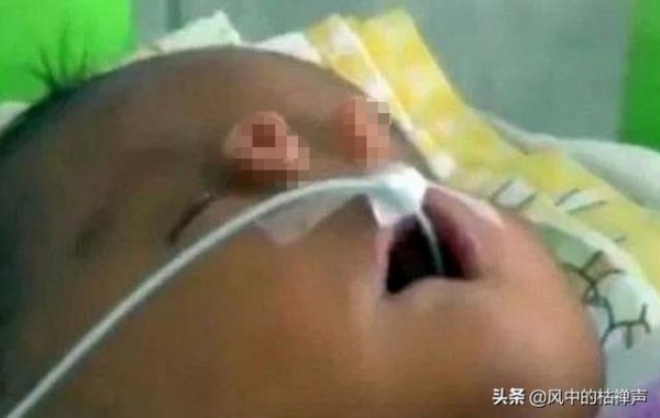 宝宝出生后，该长鼻子的地方没有长鼻子，却长着2根“小管子”