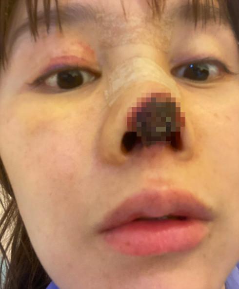 慎入31岁女星整容失败遭毁容鼻头坏死触目惊心维权无果欲跳楼2