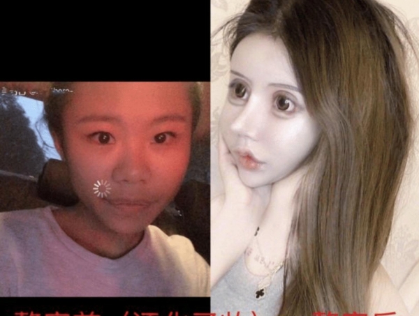 女孩13岁开始整容砸50万整成芭比娃娃如今的脸一言难尽