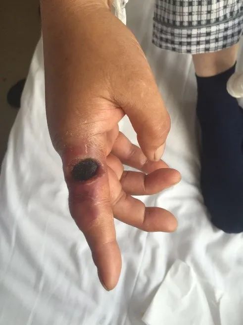 14岁学生因炭疽死亡今年至少162人感染炭疽可人传人吗