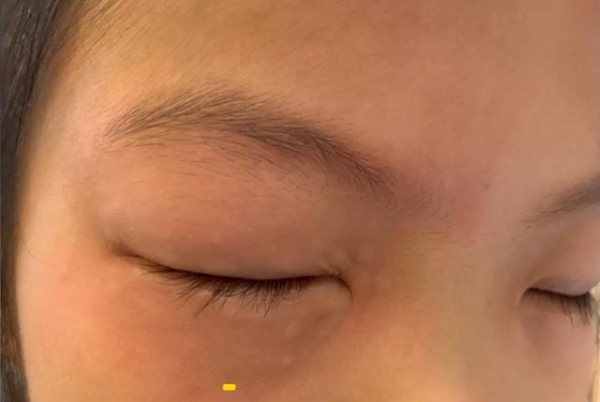 对数学题过敏？9岁小学生一做数学题眼睛肿到睁不开，家长：做语文、英语就没事