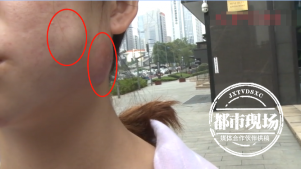 女子花1万多注射玻尿酸脸上出现2个大肿块一碰就痛