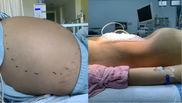 13岁女生肚子爬满“妊娠纹”，隆起似怀孕八个月，医生检查后妈妈当场吓懵