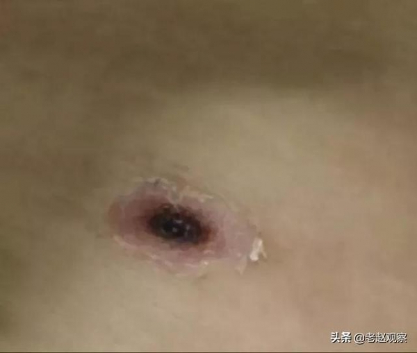 广东：佛山一女士因撸猫，患恙虫病住进ICU呼吸衰竭生命垂危