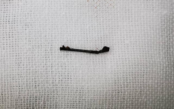 成都女子体检发现胸内金属异物，竟是一根缝衣针