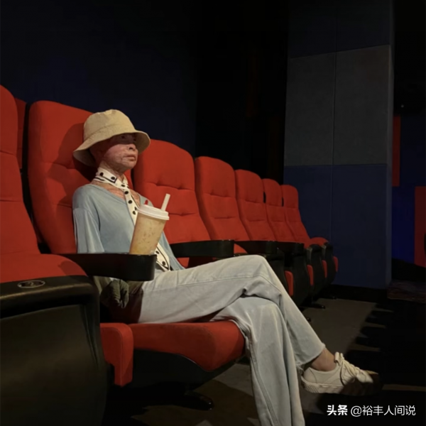 24岁女孩烧伤928天后重生！12次手术仍不放弃，向河南灾情捐500元