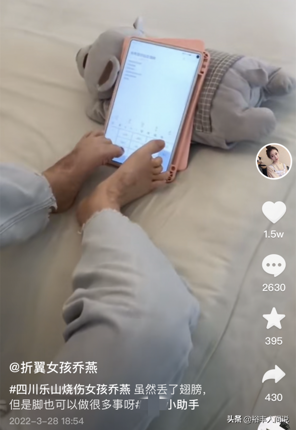 24岁女孩烧伤928天后重生！12次手术仍不放弃，向河南灾情捐500元