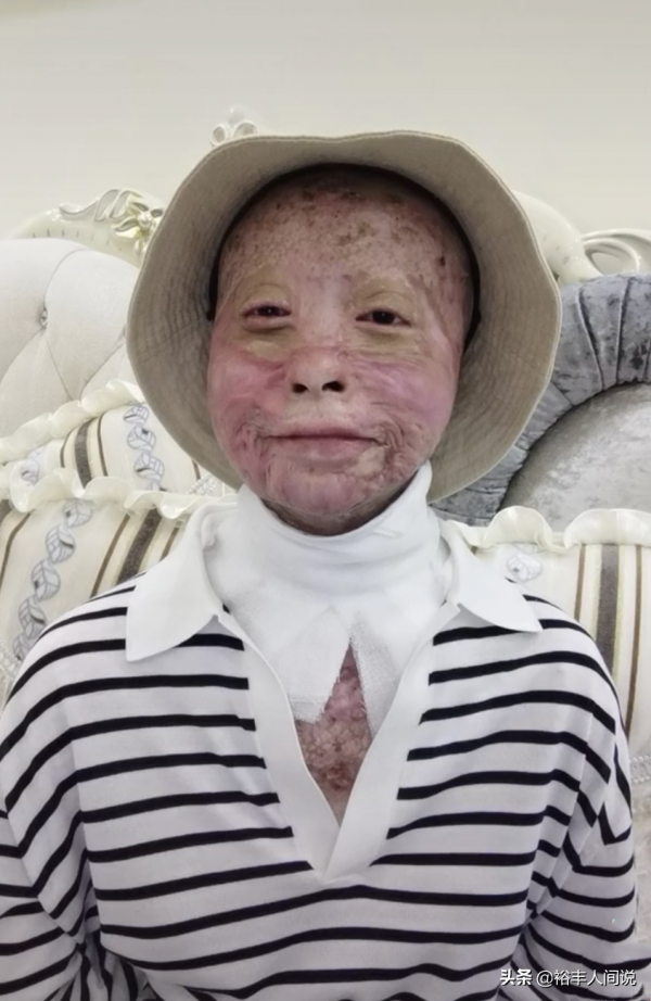 24岁女孩烧伤928天后重生！12次手术仍不放弃，向河南灾情捐500元