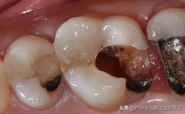 或者牙表面出现裂痕,是的牙神经出现慢性的坏死,牙齿变黑,变脆
