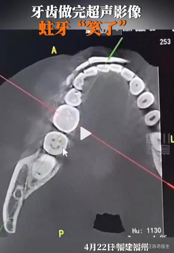 拍牙齿CT发现蛀牙蛀成一张笑脸，网友：这是C型根管