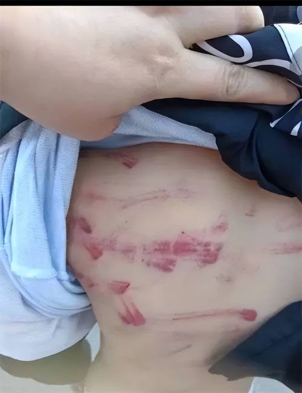 因做错数学题,三年级小学生被老师打得遍体鳞伤?警方介入