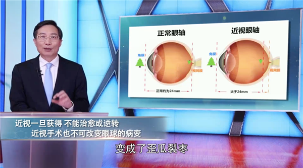 眼科专家透露真相：近视手术不能治愈近视！