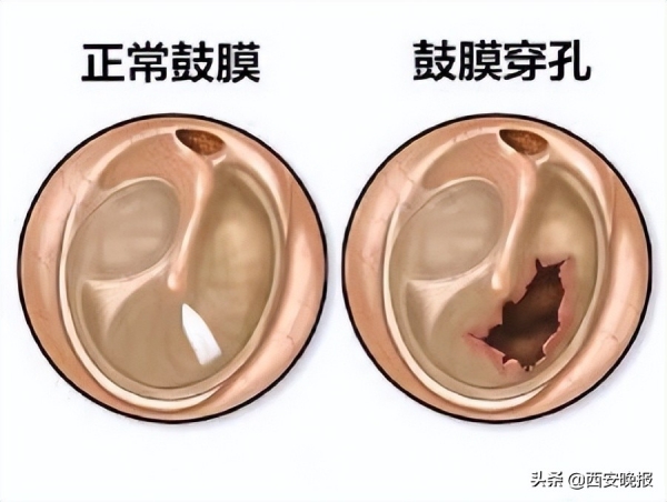 ä¸å·´ææ²¡æææ­»èå­ ååæè³é¼èæç©¿å­
