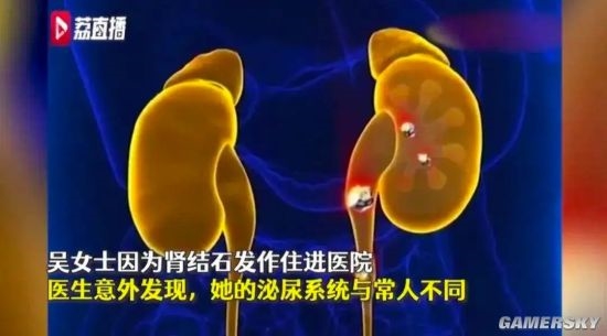 女子天生4条输尿管、4个肾 竟全部长结石