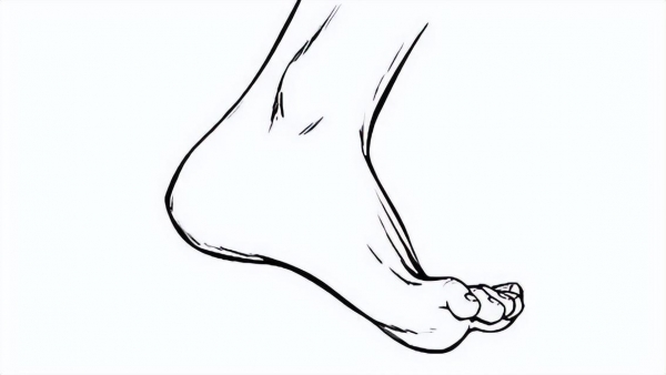 糖尿病人请注意:双脚出现这3种异常,预示糖尿病足要来了