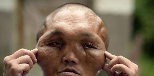 重庆男子整个头肿大特像外星人的样子