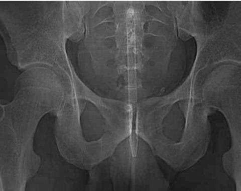 看X光下那些意外进入身体的异物！个个奇葩搞笑