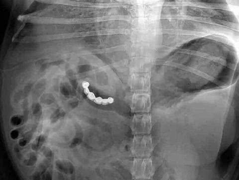 看X光下那些意外进入身体的异物！个个奇葩搞笑