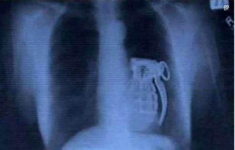 看X光下那些意外进入身体的异物！个个奇葩搞笑