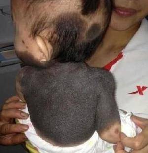 4岁女孩上半身长满黑斑连医生都束手无策