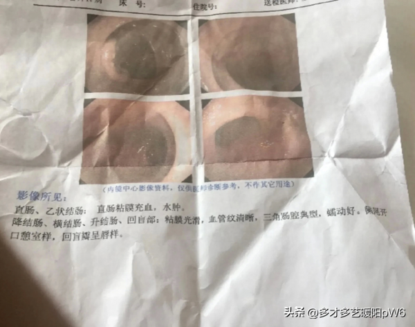 女孩洗澡摔倒 6厘米塑料棒戳进肛门