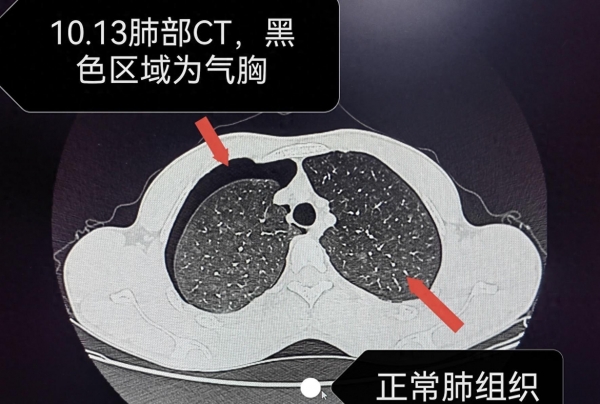 气胸x线胸片表现图片