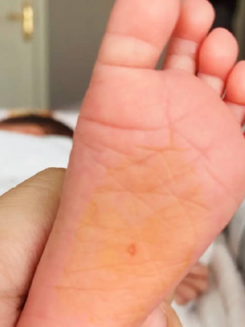 宝妈称月嫂抠破婴儿脚底不让白天睡觉，月嫂：用力不当导致