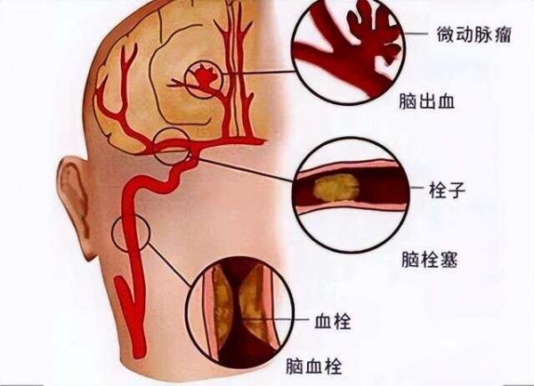 上海交大解剖260名脑梗死者，惊奇发现：患脑梗的人，有5大共性